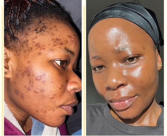 Dark spot moisturize cream