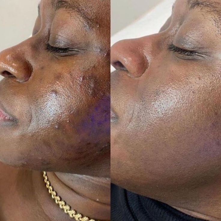 Dark spots removal cream