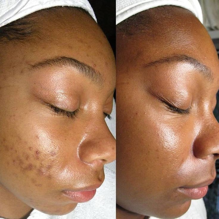 Dark spots removal cream